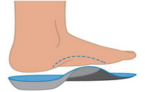 การใส่แผ่นรองเท้าเป็นวิธีการรักษา